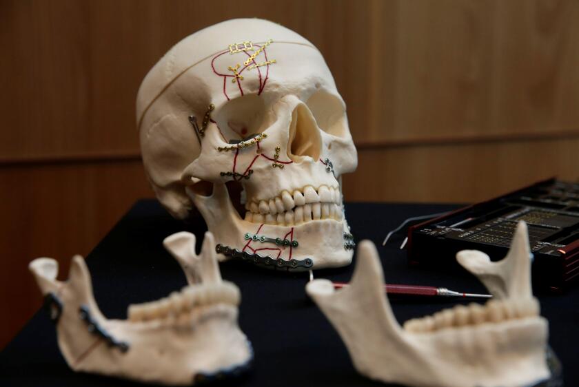 A skull with titanium plates of Medartis, a Swiss producer of metal implants for the surgical management of fractures, is seen during a news conference to present the planned IPO, in Zurich, Switzerland March 12, 2018. REUTERS/Moritz Hager